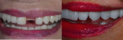 All-on-4 Dental Implants before and after photo