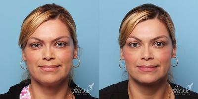 Botox before and after photo