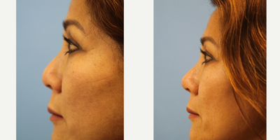 Nonsurgical Nose Job before and after photo