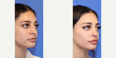 Rhinoplasty before and after photo
