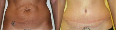 Tummy Tuck before and after photo