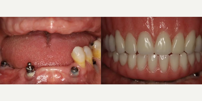All-on-4 Dental Implants before and after photo