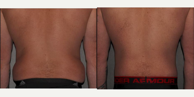 Body Lift before and after photo