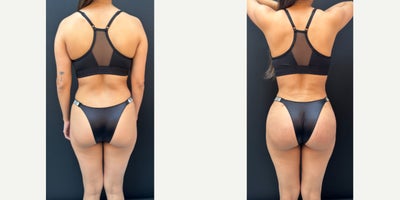 Brazilian Butt Lift before and after photo