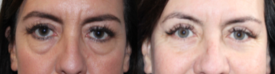 Eyelid Surgery before and after photo