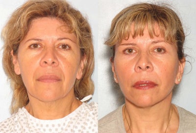 Facelift before and after photo