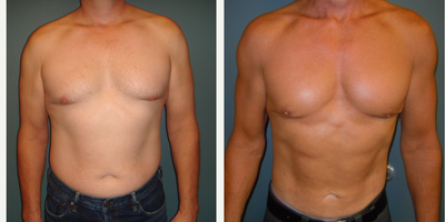Laser Liposuction before and after photo