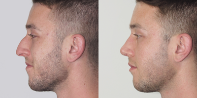 Rhinoplasty before and after photo