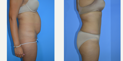 Tummy Tuck before and after photo