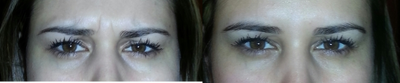 Botox before and after photo