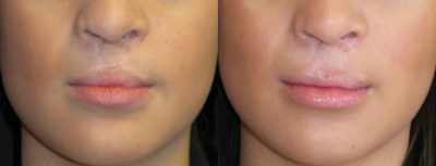 Lip Fillers before and after photo