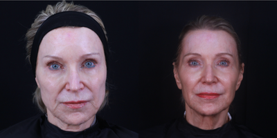 Restylane Lyft before and after photo