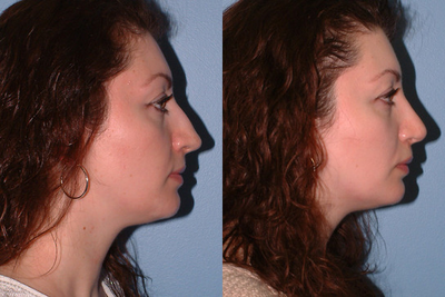 Rhinoplasty before and after photo