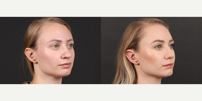 Rhinoplasty before and after photo