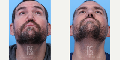 Septoplasty before and after photo