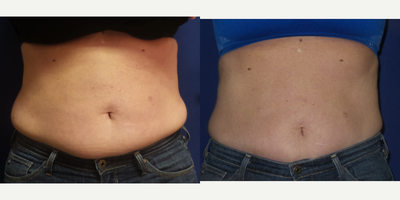 Vanquish before and after photo