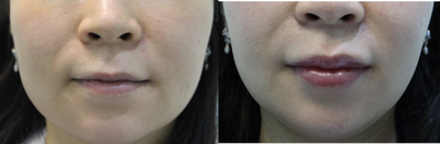 Botox before and after photo