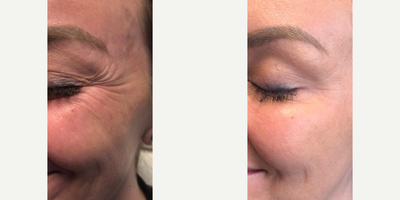 Botox before and after photo