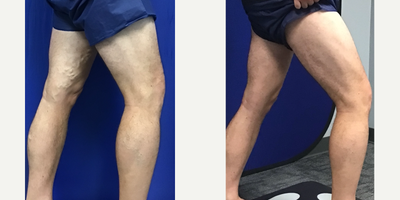EVLT before and after photo