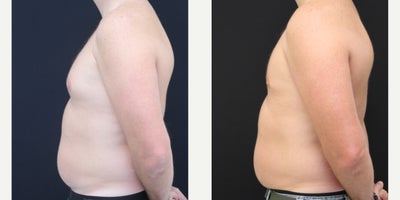Gynecomastia Surgery before and after photo