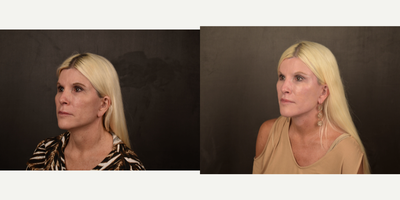 Lip Lift before and after photo