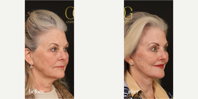 Lip Lift before and after photo