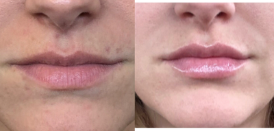 Restylane before and after photo