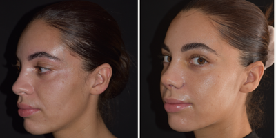 Rhinoplasty before and after photo