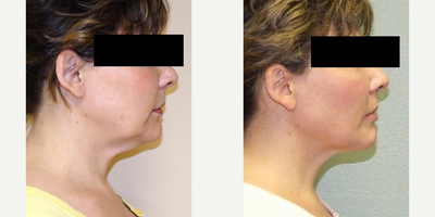 Smart Lipo before and after photo