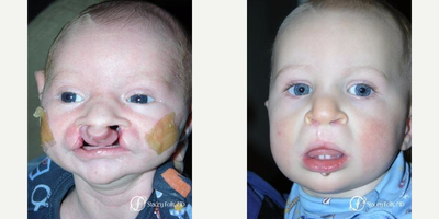 Cleft Lip And Palate Repair before and after photo