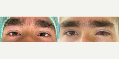 Strabismus Surgery before and after photo