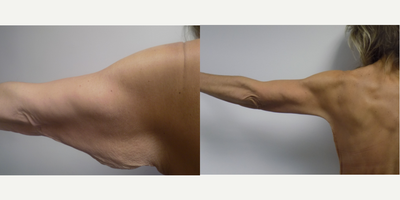Arm Lift before and after photo