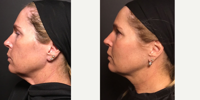 Nonsurgical Neck Lift before and after photo