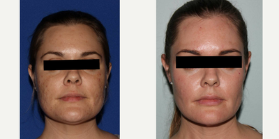 CO2 Laser before and after photo