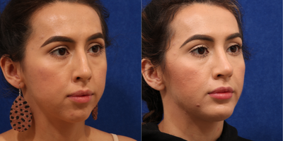 Chin Liposuction before and after photo