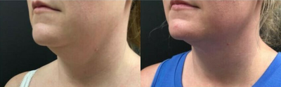 CoolSculpting before and after photo