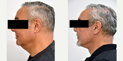Facelift before and after photo