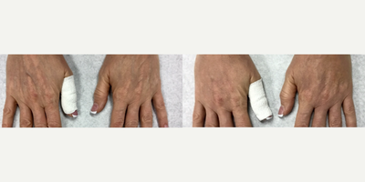 Hand Rejuvenation before and after photo