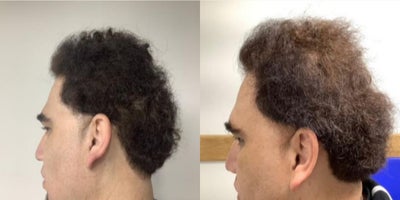 PRP for Hair Loss before and after photo