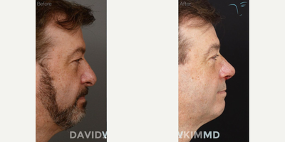 Rhinoplasty before and after photo