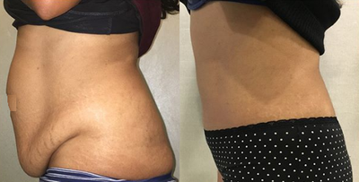 Tummy Tuck before and after photo