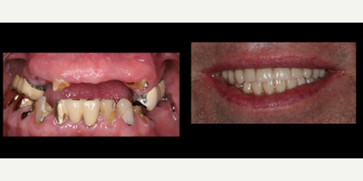 All-on-4 Dental Implants before and after photo