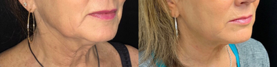 Radiesse before and after photo