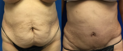 Tummy Tuck before and after photo