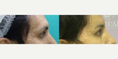 Forehead Reduction before and after photo