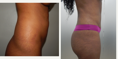 Mini Tummy Tuck before and after photo