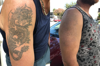 PicoSure before and after photo