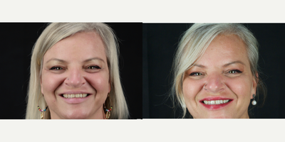 Sculptra before and after photo