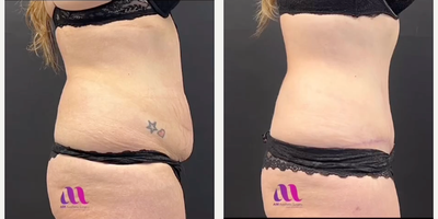 Tummy Tuck before and after photo