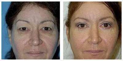 Eyelid Surgery before and after photo